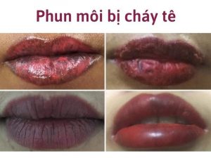 Phun môi bị cháy tê là hiện tượng gì?