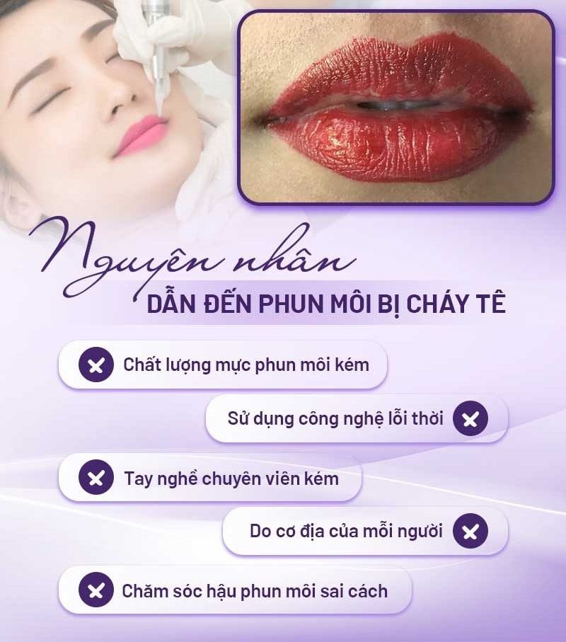 Những nguyên nhân chính dẫn đến việc phun môi bị cháy tê