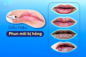 Những hình ảnh xăm môi bị hỏng thường có các dấu hiệu môi bị nổi mụn nước, môi bị mủ, thâm đen, không lên màu, viền môi bị lộ