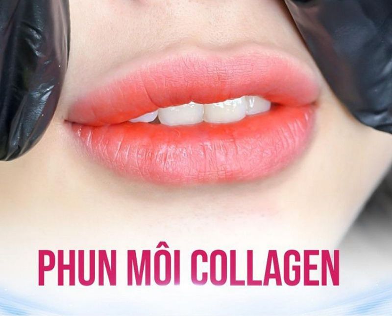 Kỹ thuật phun môi Collagen