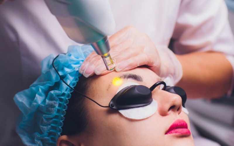 Xử lý chân mày trổ màu bằng công nghệ Laser