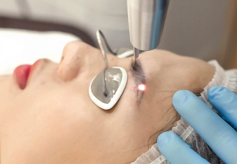 Xoá lông mày bao lâu thì làm lại được? Xoá xăm mày bằng tia laser ít gây tổn thương